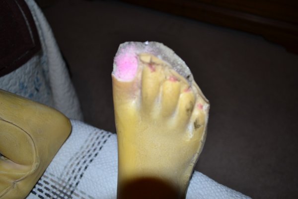 Right foot seam split and missing big toe.