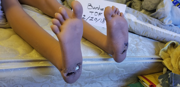 Foot tearing and exposed skeleton from standing pressures. 1st time doll owner mistake